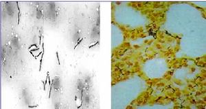 （圖）肺炭疽