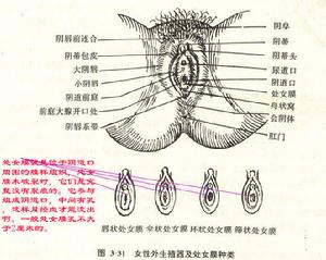 處女膜閉鎖