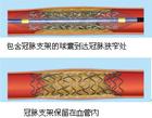 支架植入