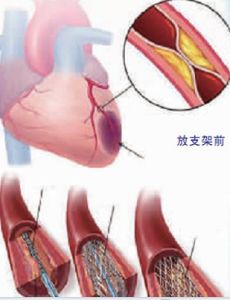 急性冠脈綜合徵