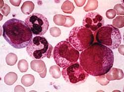 （圖）慢性髓細胞白血病