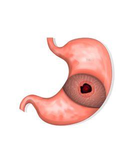 胃十二指腸潰瘍瘢痕性幽門梗阻