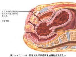 陰道橫膈切除術