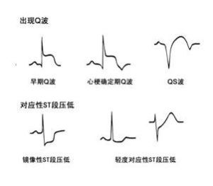 病理性Q波