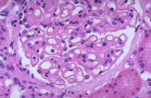 隱匿性腎小球腎炎 隱匿性腎小球腎炎