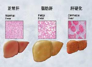 老年肝硬化