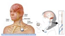 迷走神經刺激器