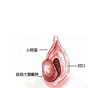 前庭大腺