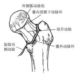 缺血型股骨頭壞死