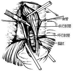 經膈肌肋間疝