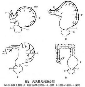 先天性短結腸