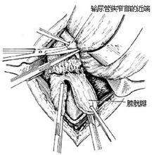 圖9:在狹窄部位以上切斷輸尿管(示意圖)