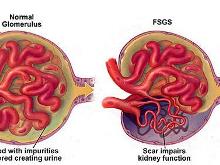 局灶節段性腎小球硬化