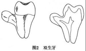 雙牙畸形