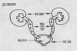 輸尿管損傷