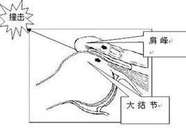 撞擊征