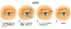 下瞼下至