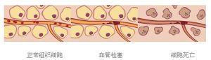 冷凍時導致血管收縮，血流減緩，冰晶形成，最終血流停止