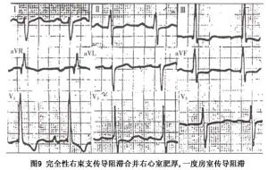 右束支傳導阻滯 心電圖