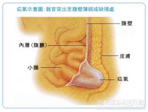 小腸疝