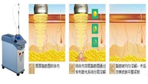 雷射溶脂