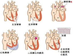 心源性休克常見病因