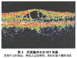 黃斑囊樣水腫