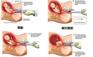 人流減肥法