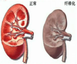 溶血尿毒綜合症