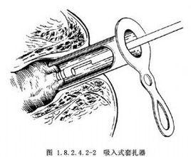 膠圈套扎法治療內痔