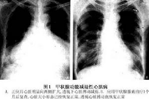 甲狀腺功能減退性心肌病