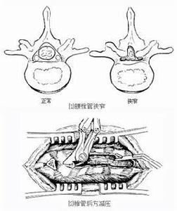 腰椎管、根管擴大減壓術