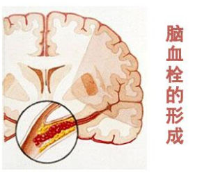 腦血栓後遺症