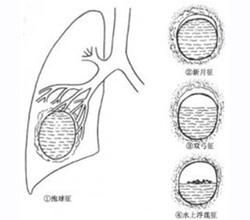 急性膿胸