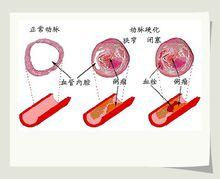 閉塞性動脈硬化症