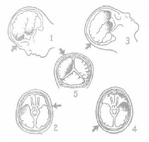 閉合性腦損傷