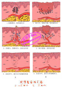 二期癒合