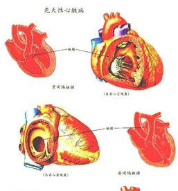 貧血性心臟病