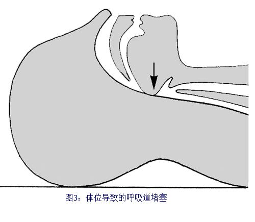 急性呼吸道堵塞