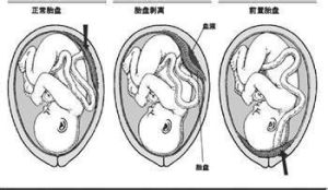 先兆性流產