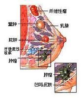 乳腺癌皮膚轉移