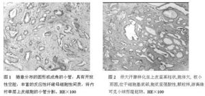 乳腺小管癌