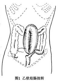 乙狀結腸扭轉