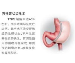胃繞道減肥手術