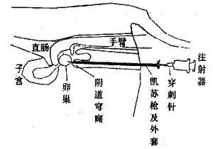 牛卵巢囊腫