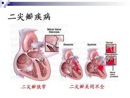 先天性心臟瓣膜病