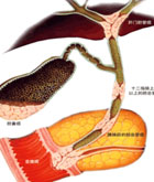 膽管良性狹窄