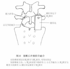 腰部峽部崩裂和脊椎滑脫