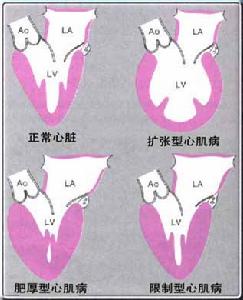 甲狀腺功能減退性心肌病