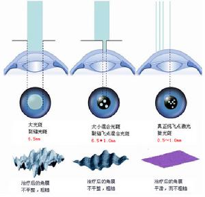 準分子雷射手術